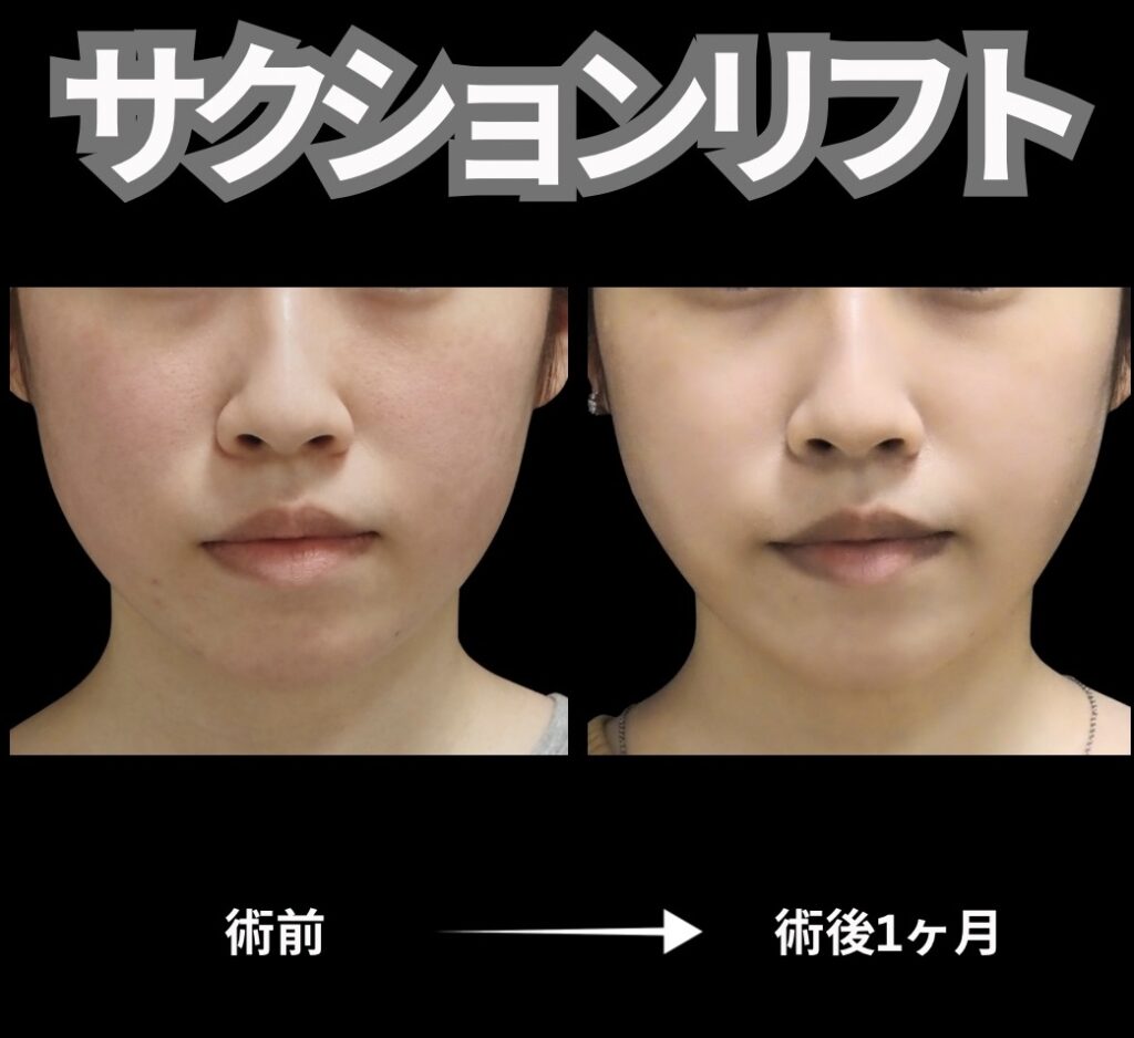 顔脂肪吸引と糸リフト6本の症例写真