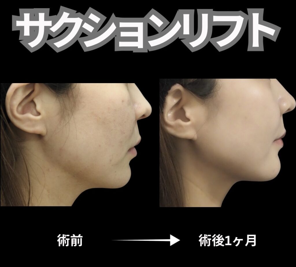 顔脂肪吸引と糸リフト6本を組み合わせた施術の症例写真