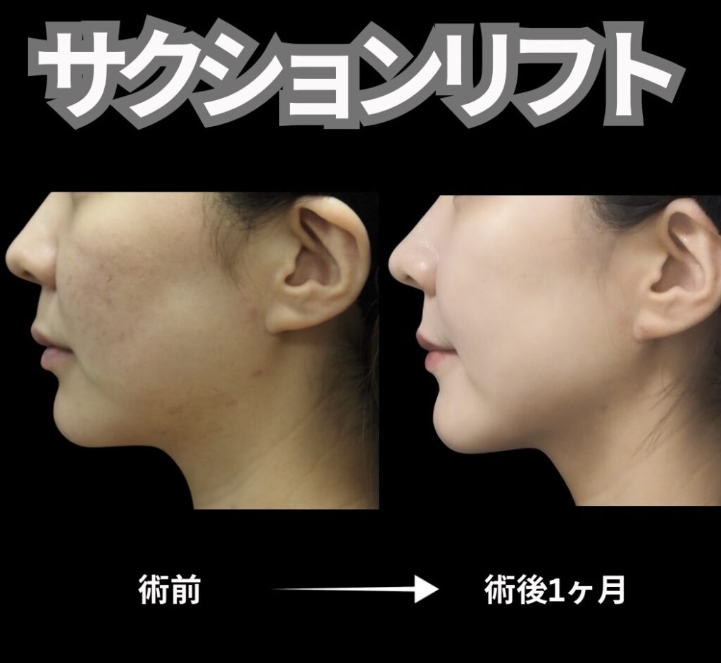 顔脂肪吸引と糸リフト6本を組み合わせた施術の症例写真