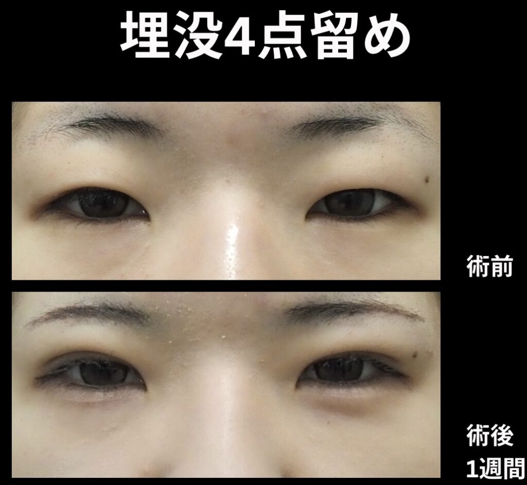 埋没4点留めの症例写真