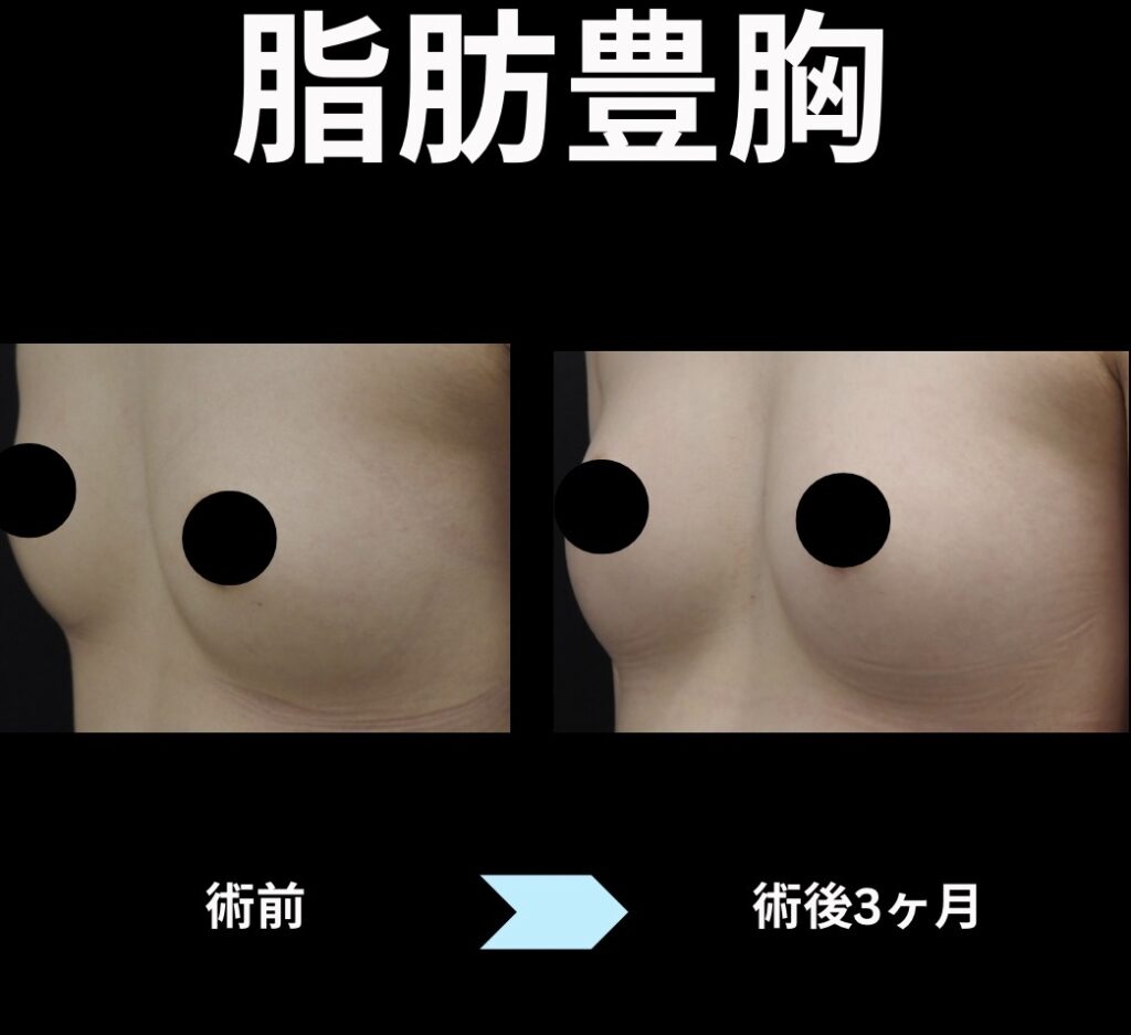脂肪豊胸の症例写真