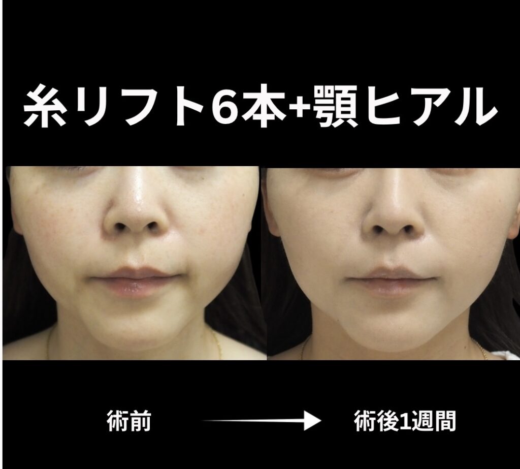 糸リフト6本挿入+顎ヒアルロン酸注入の症例写真