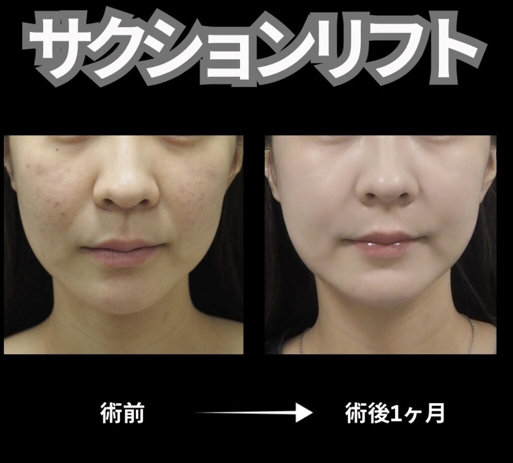 顔脂肪吸引と糸リフト6本を組み合わせた施術の症例写真