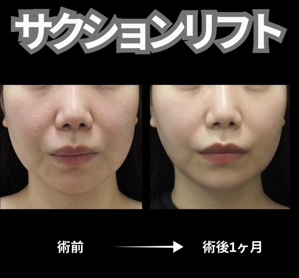 顔脂肪吸引と糸リフト6本の症例写真