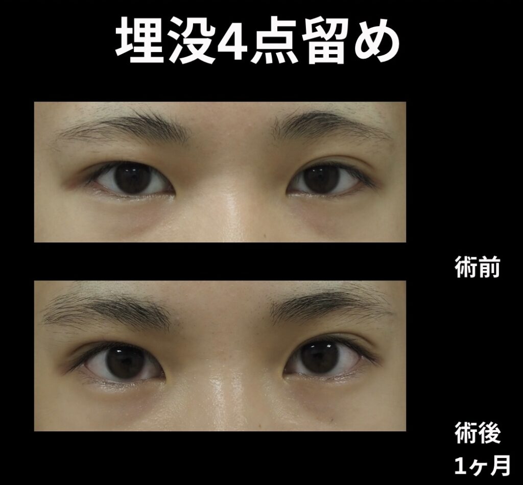 埋没4点法の症例写真