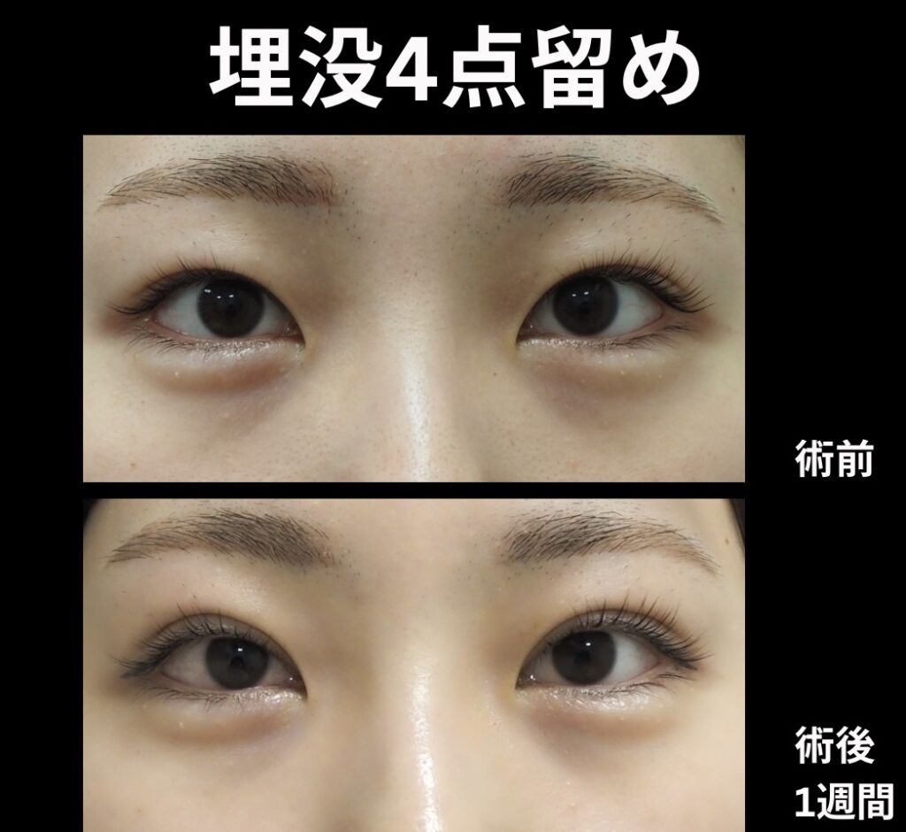 埋没4点法の症例写真