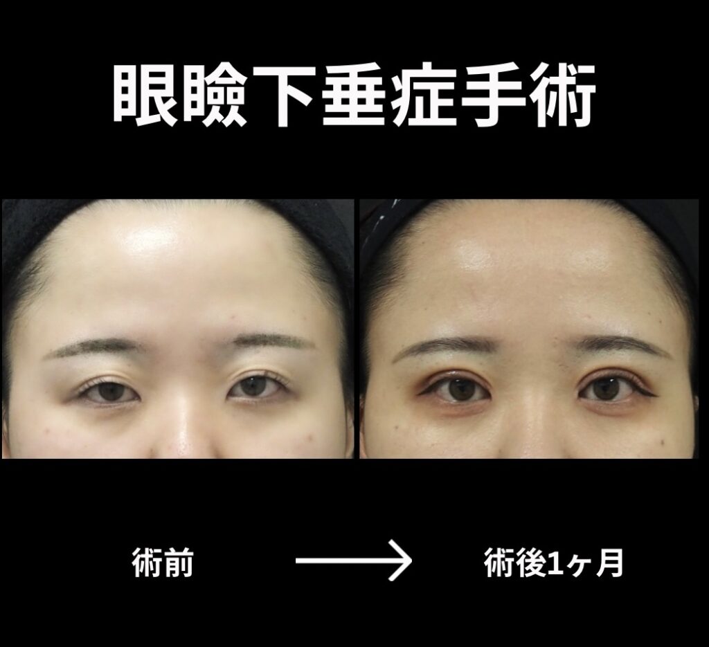 眼瞼下垂症手術の症例写真