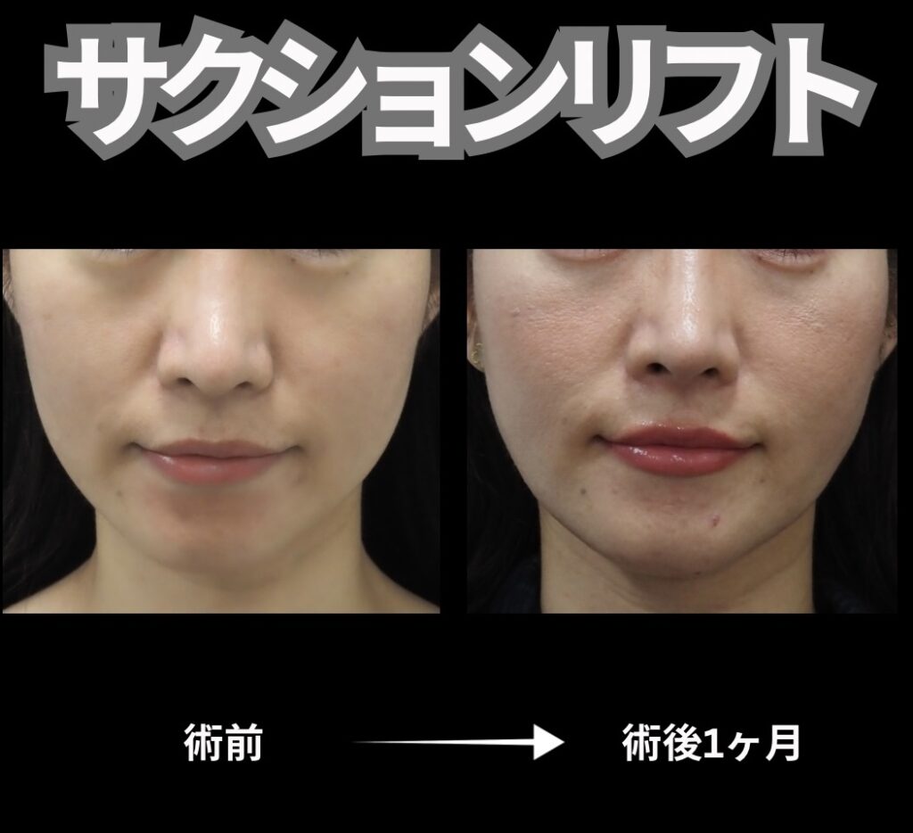 サクションリフトの症例写真