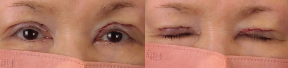 眼瞼下垂症手術直後の写真