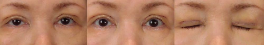 眼瞼下垂症手術後1週間の写真