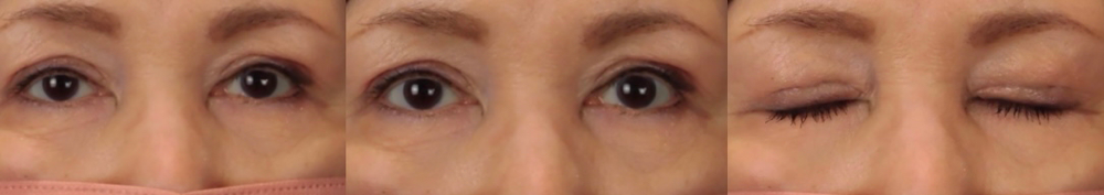 眼瞼下垂症手術後２週間の写真