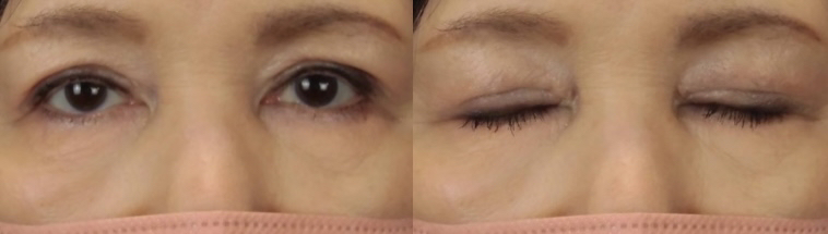 眼瞼下垂症手術後１ヶ月の写真