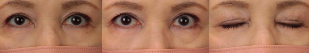眼瞼下垂症手術後３ヶ月の写真