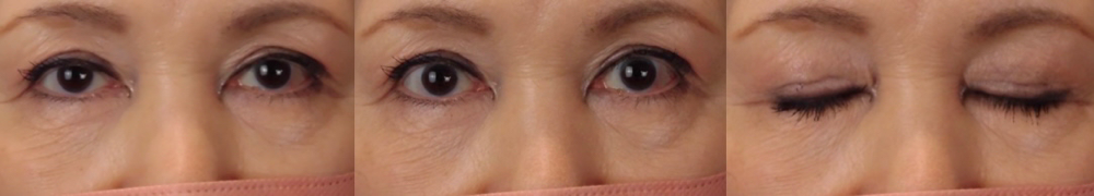 眼瞼下垂症手術後６ヶ月の写真