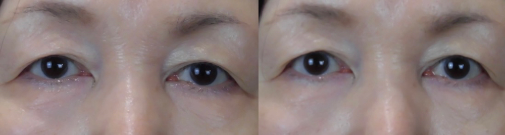 眼瞼下垂症手術前の写真