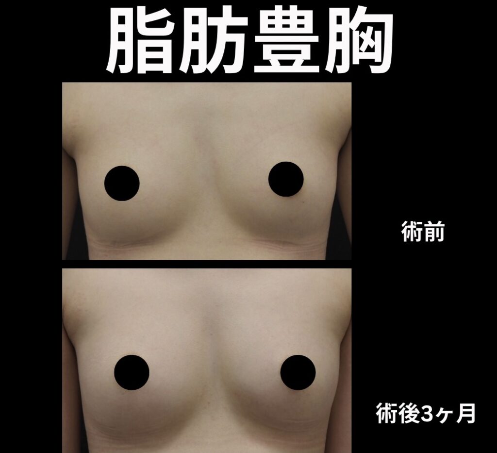 脂肪豊胸の症例写真
