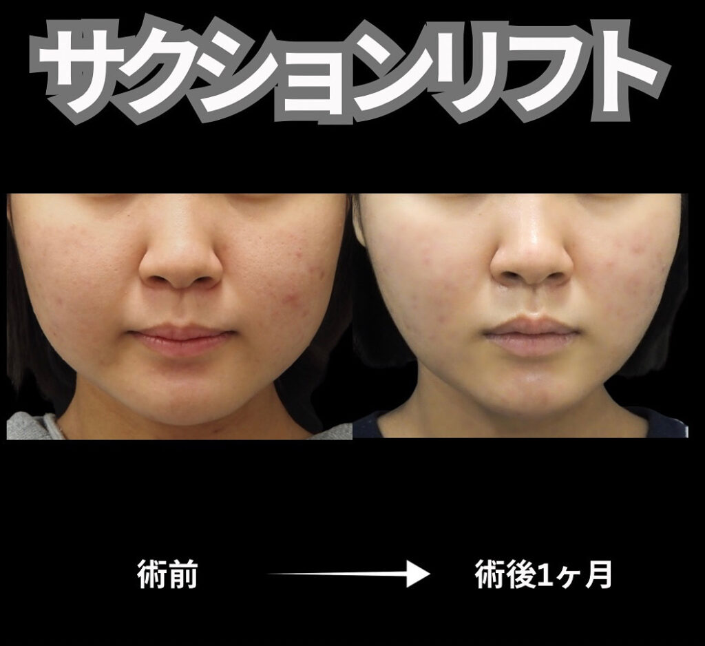 顔脂肪吸引と糸リフトを組み合わせた施術の症例写真