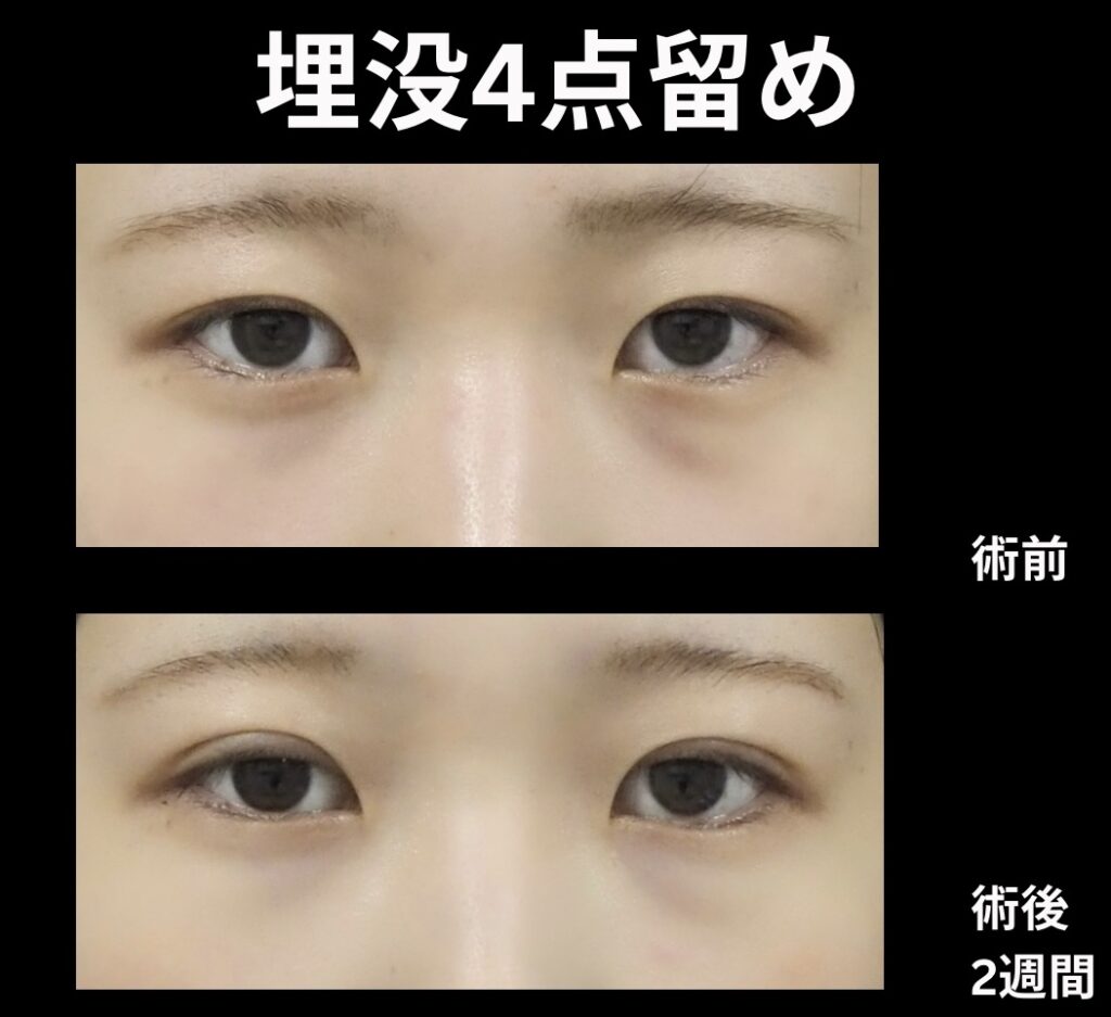 埋没4点法の症例写真