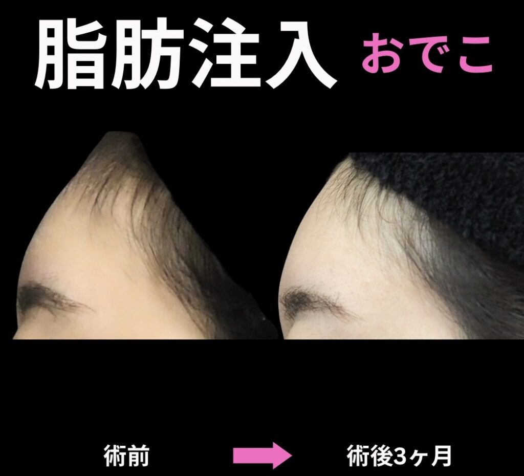 脂肪注入(おでこ)の症例写真