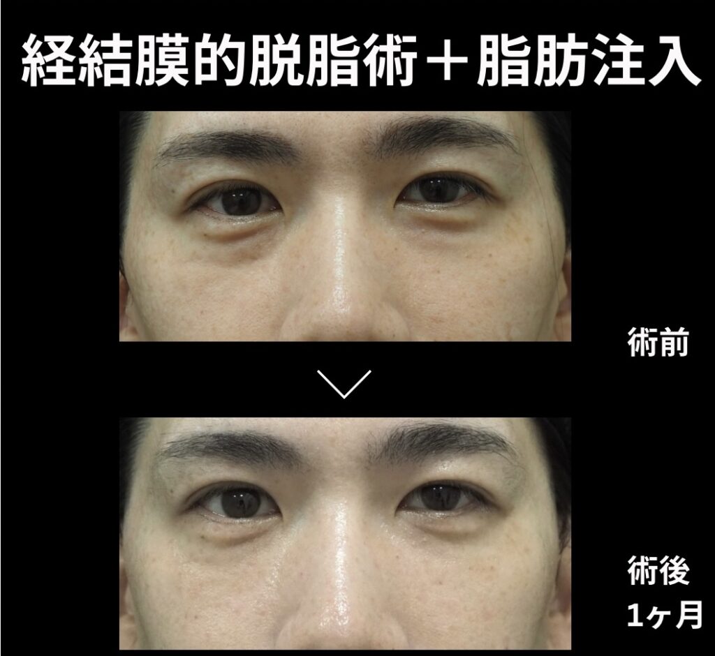 経結膜的脱脂術+脂肪注入(目の下)の症例写真