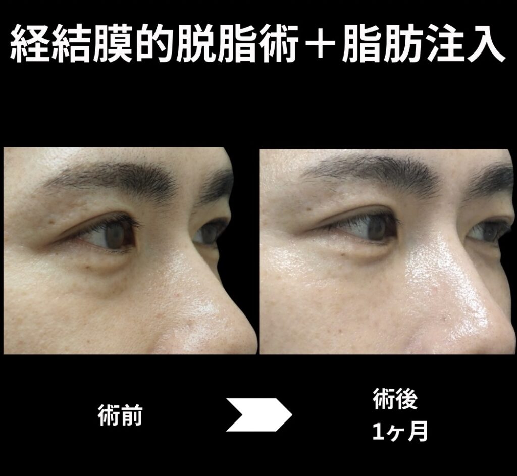 経結膜的脱脂術+脂肪注入(目の下)の症例写真