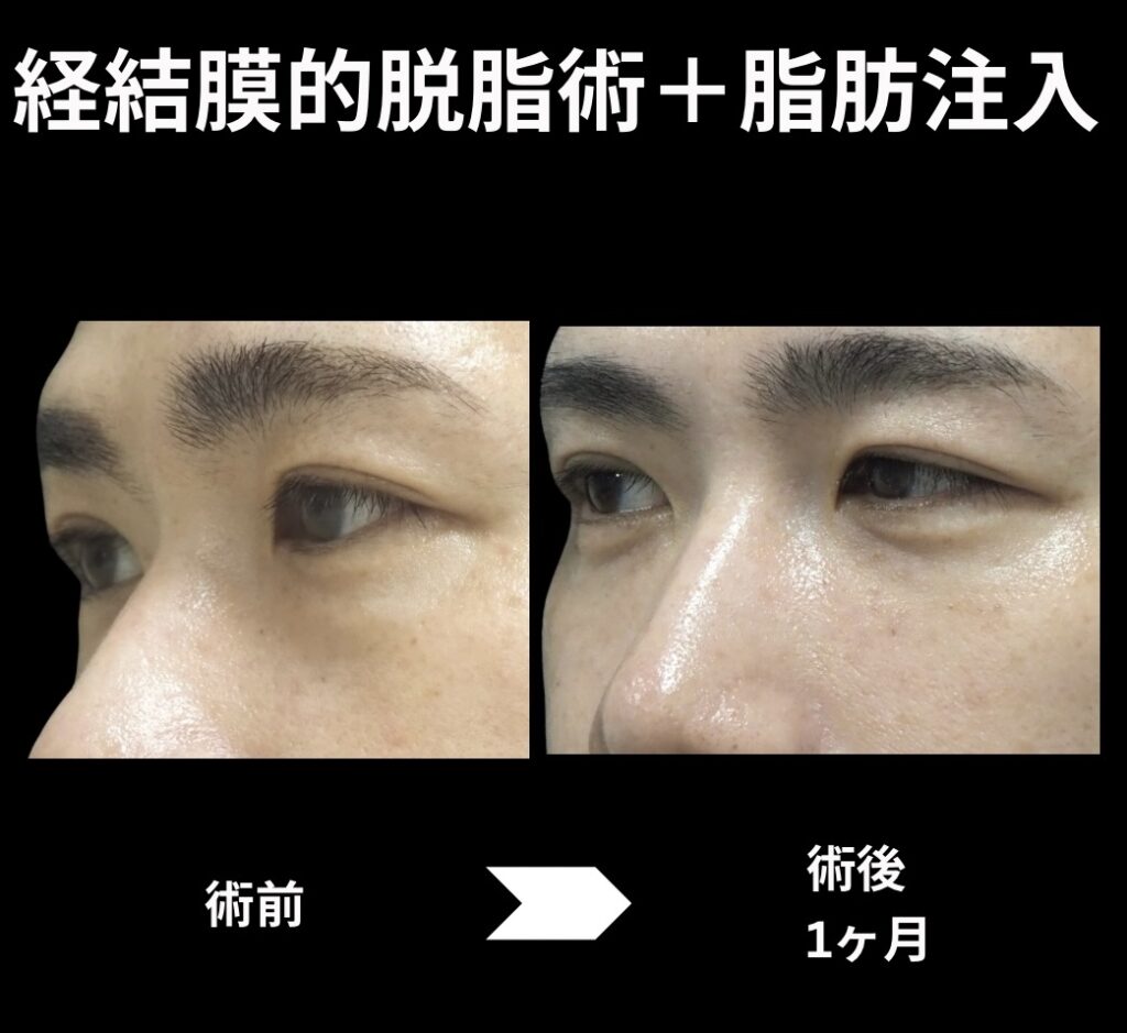 経結膜的脱脂術+脂肪注入(目の下)の症例写真