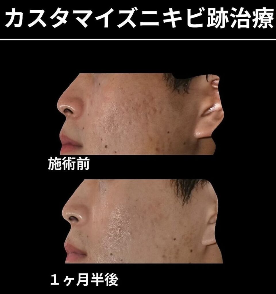 ニキビ跡に対して、サブシジョン・ピコフラクショナル・プルリアル2cc注入した症例