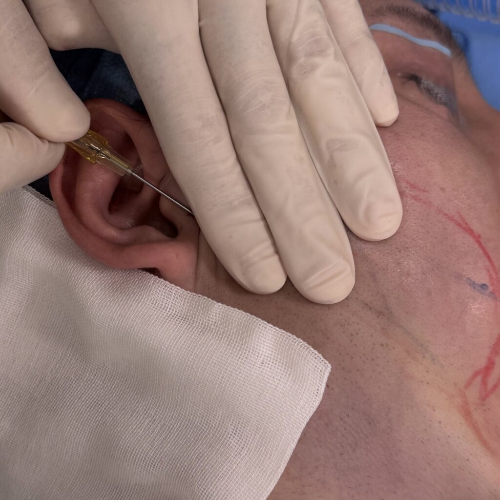 サクションリフトの流れに関する画像