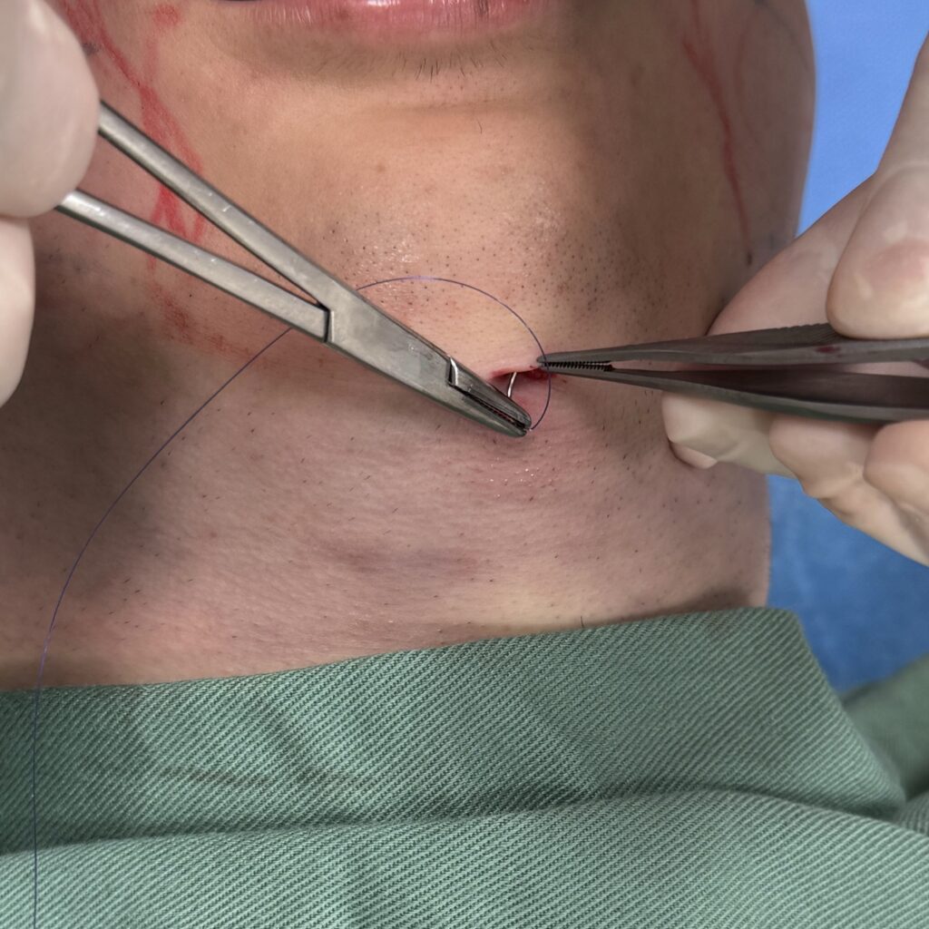 サクションリフトの流れに関する画像