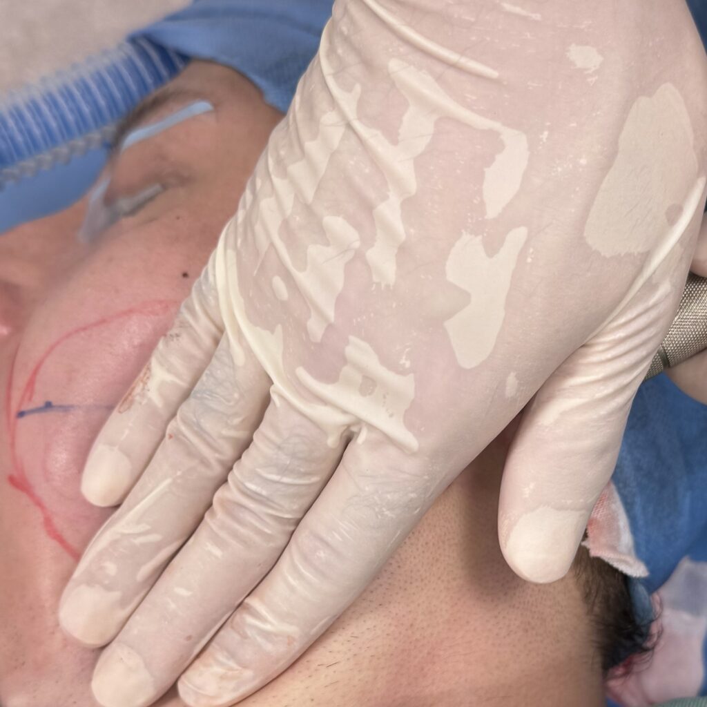 サクションリフトの流れに関する画像