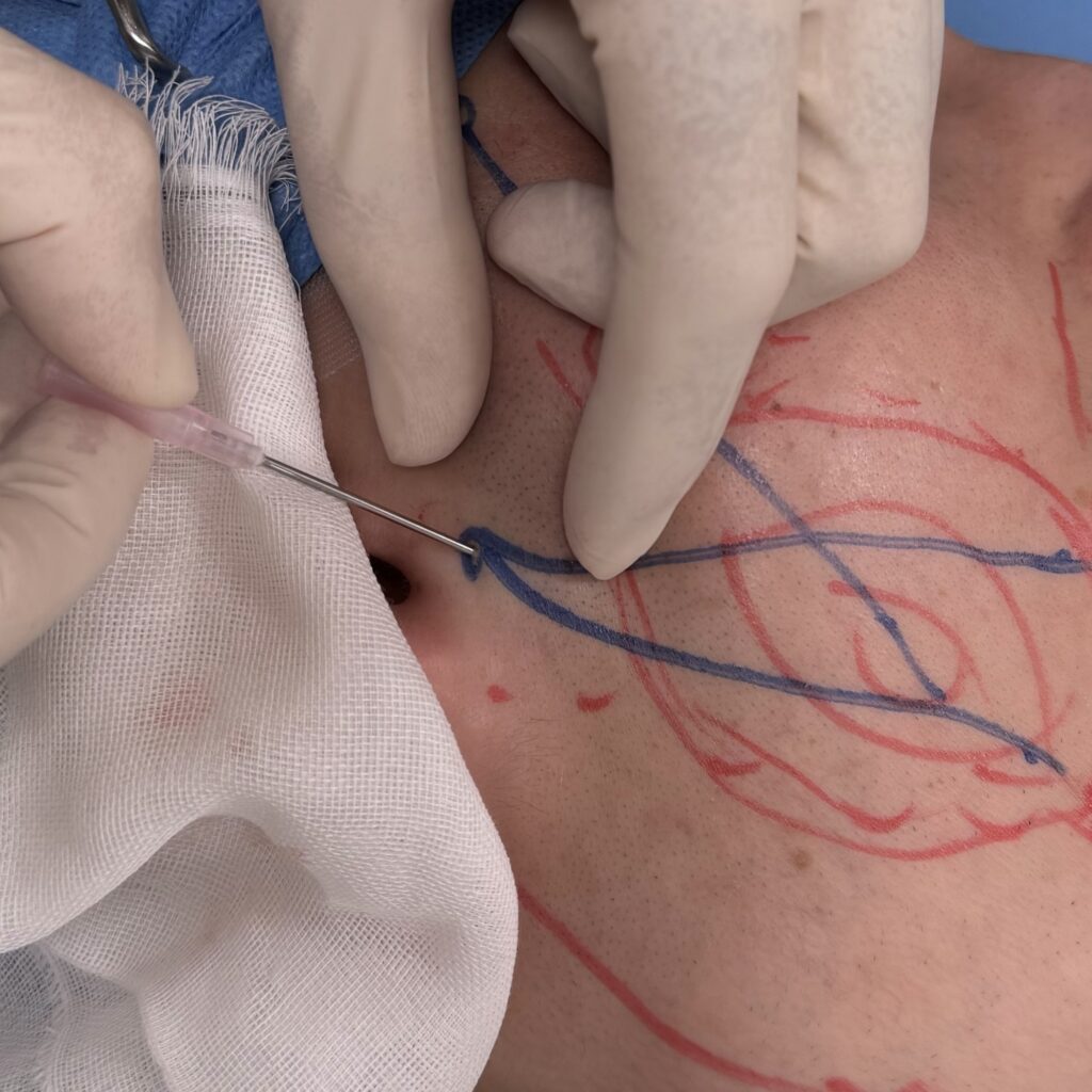 サクションリフトの流れに関する画像