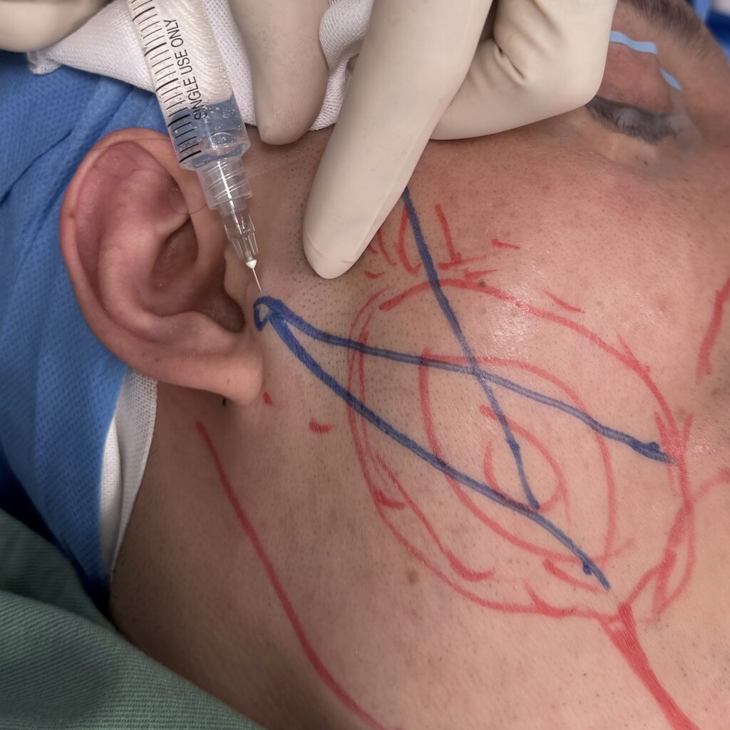 サクションリフトの流れに関する画像