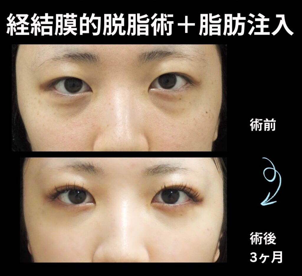 経結膜的脱脂術+脂肪注入(目の下)