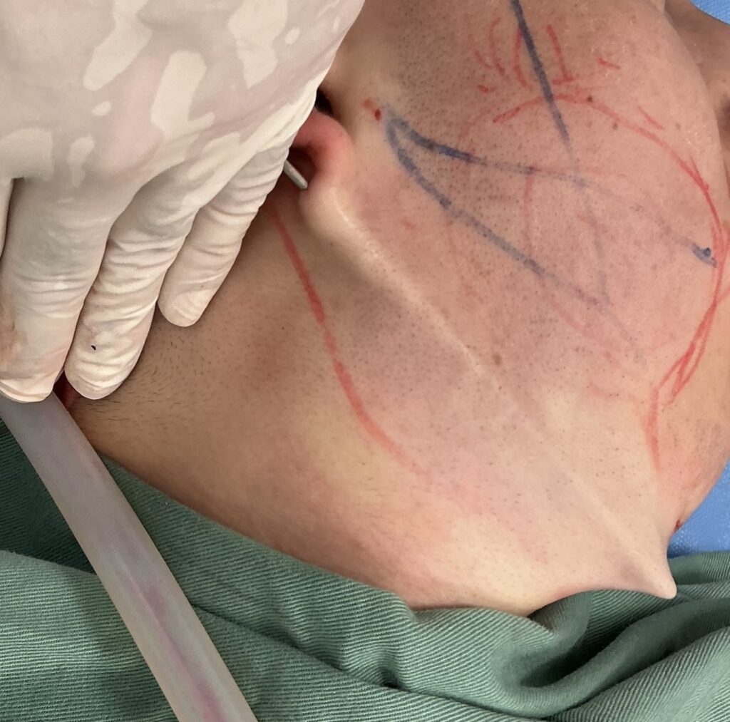 サクションリフトの流れに関する画像