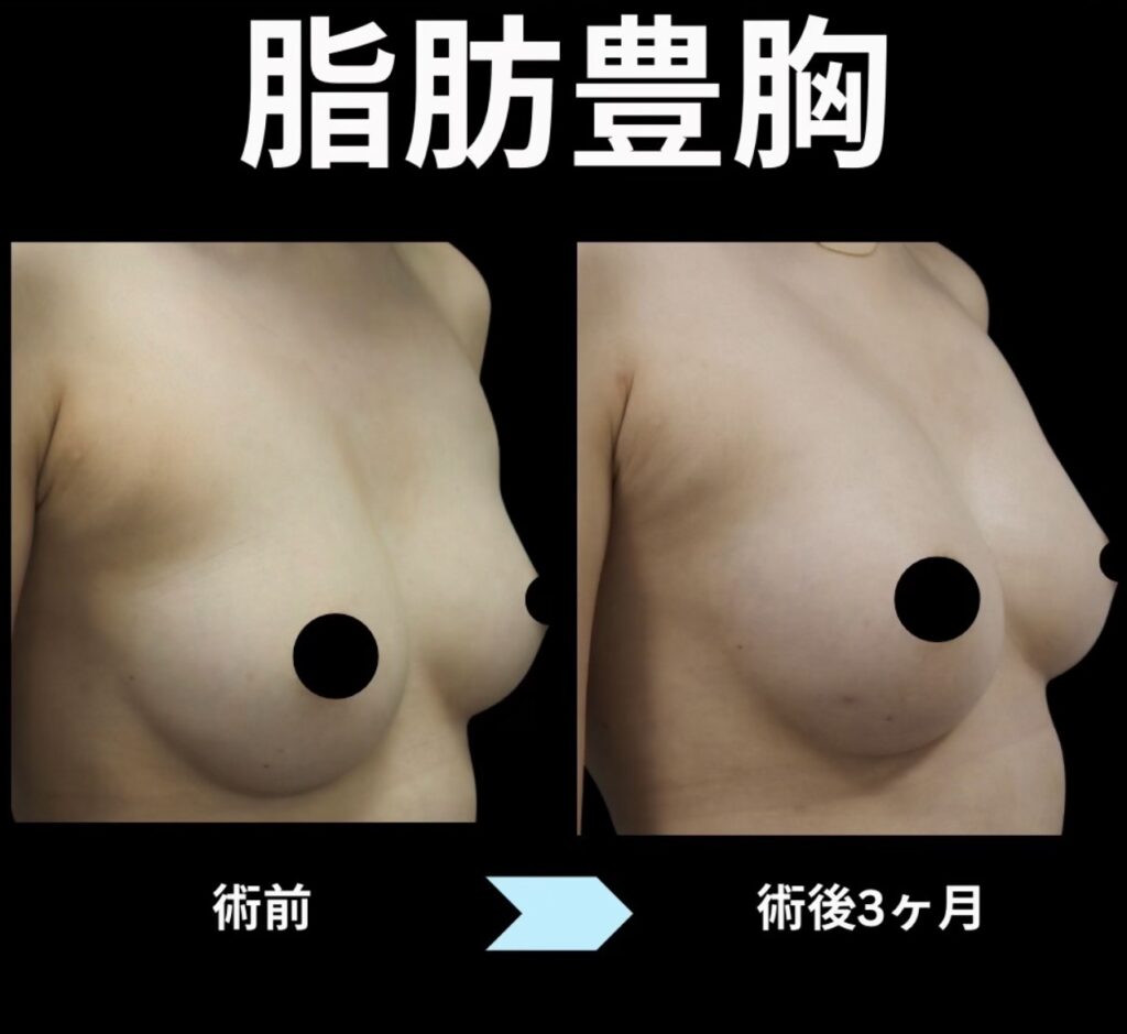 脂肪豊胸の症例写真