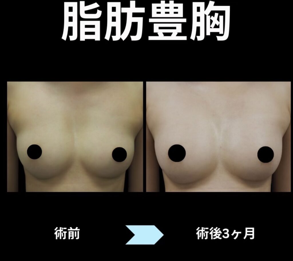 脂肪豊胸の症例写真