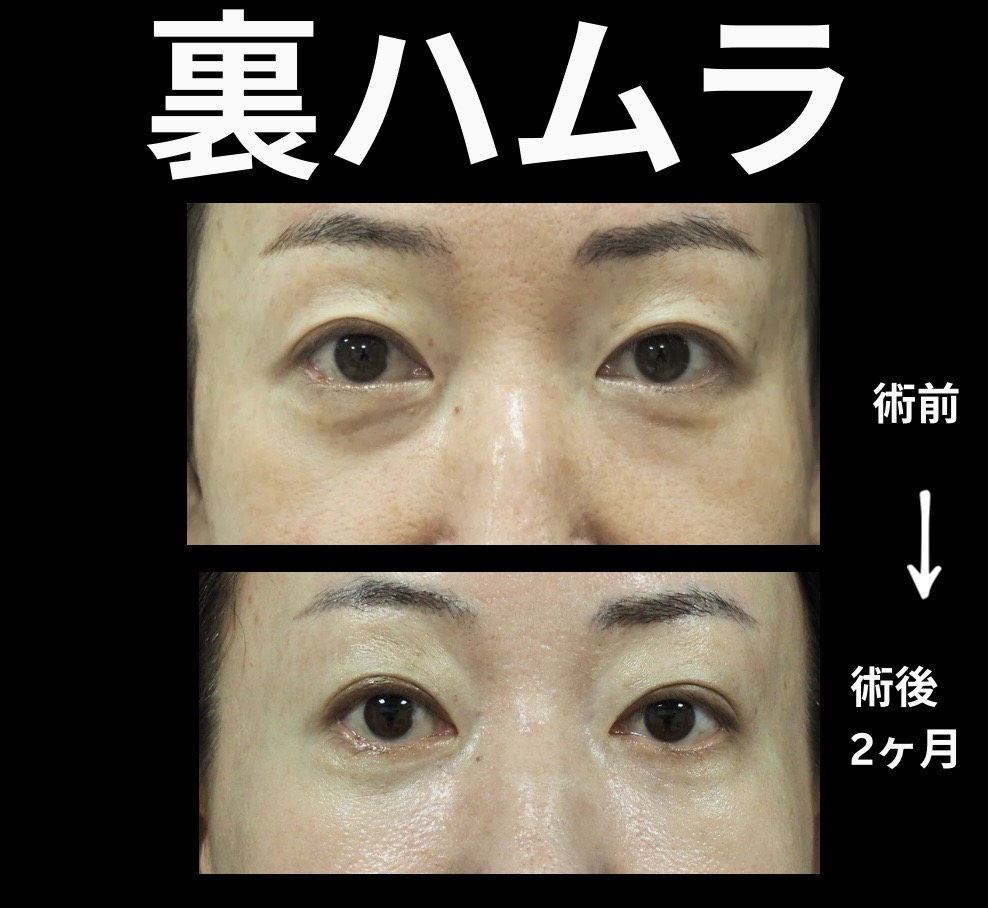 裏ハムラ法の症例写真