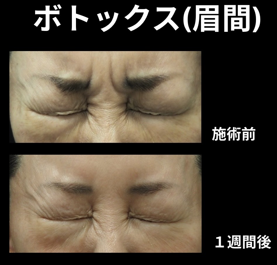 ボトックス(眉間)の症例写真