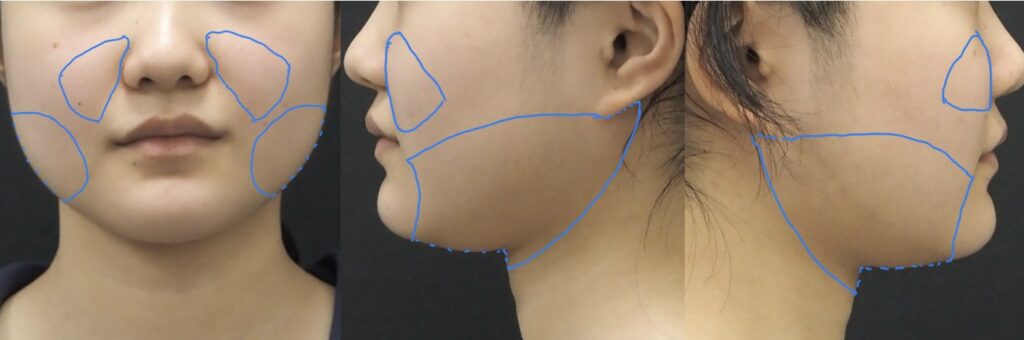 下北沢スキンクリニックにおける、顔脂肪吸引のデザイン