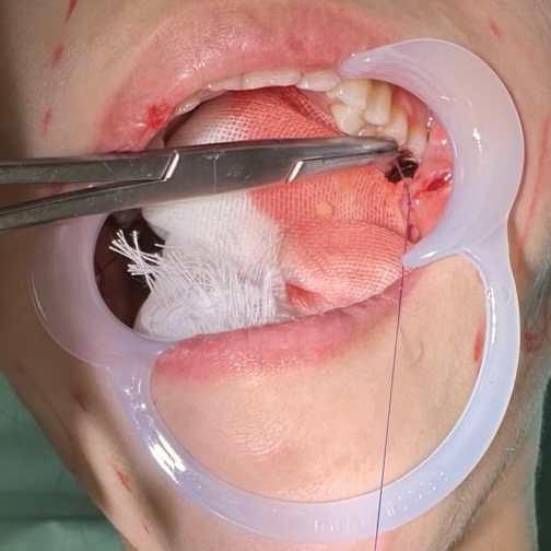 バッカルファット除去について解説している画像