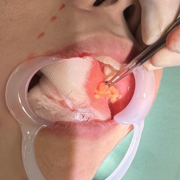 バッカルファット除去について解説している画像