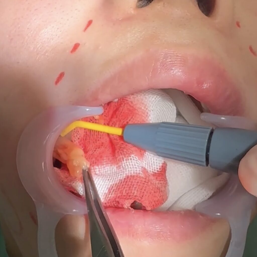 バッカルファット除去について解説している画像