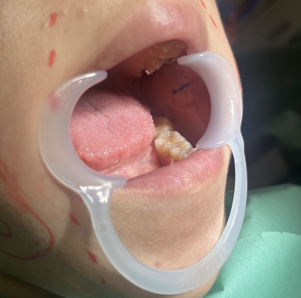 バッカルファット除去について解説している画像