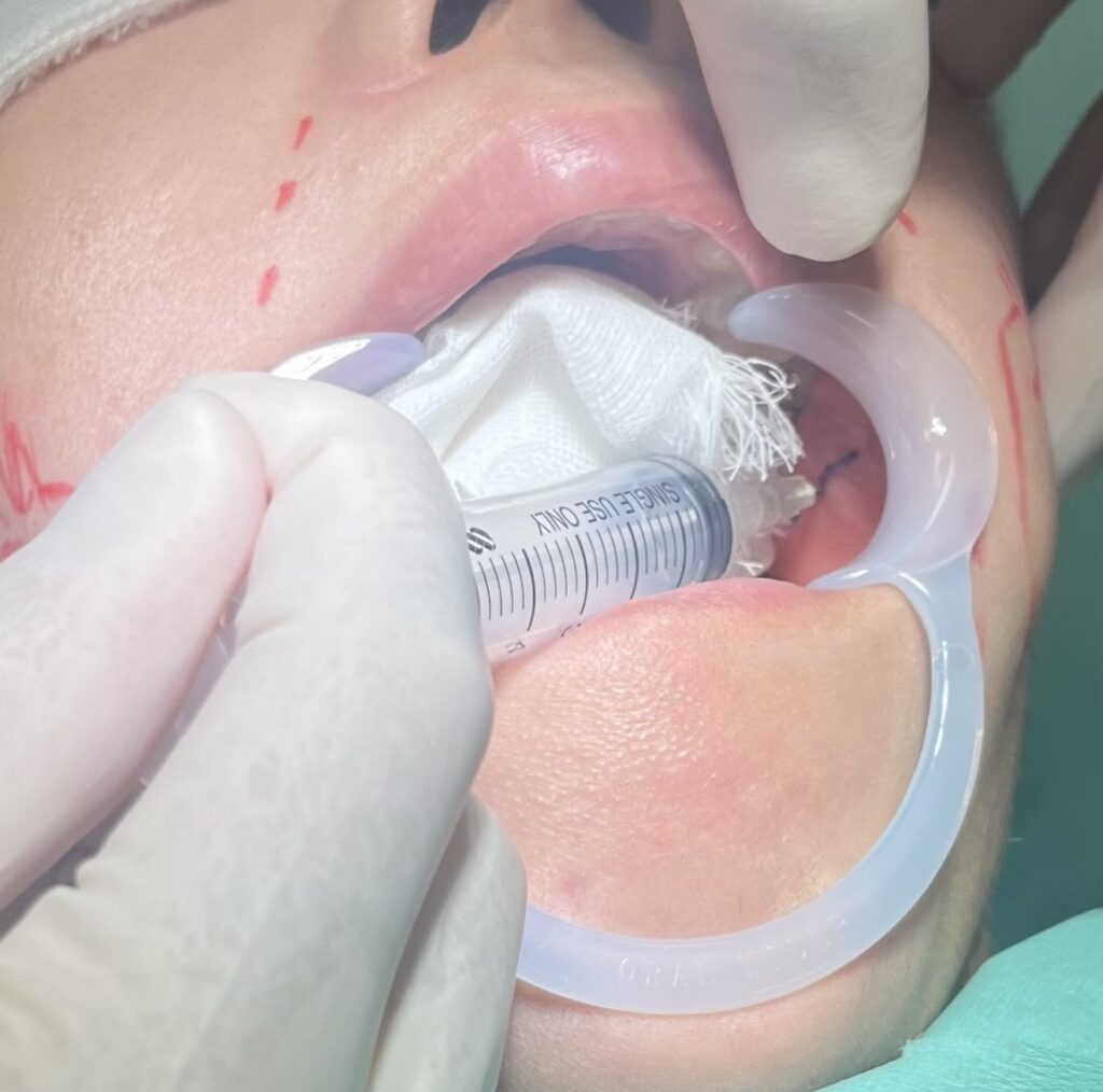 バッカルファット除去について解説している画像