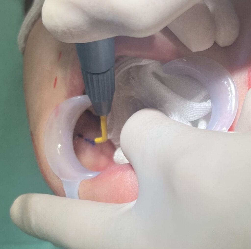 バッカルファット除去について解説している画像