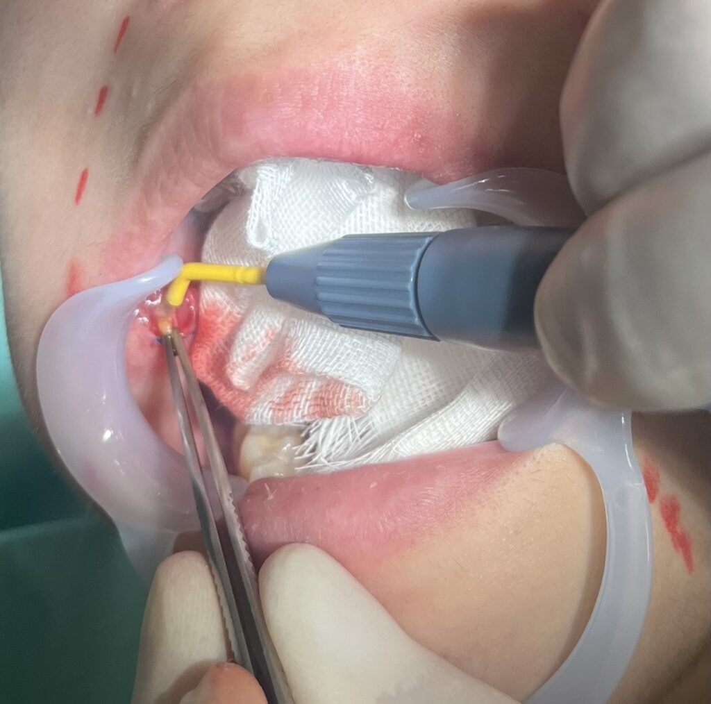 バッカルファット除去について解説している画像