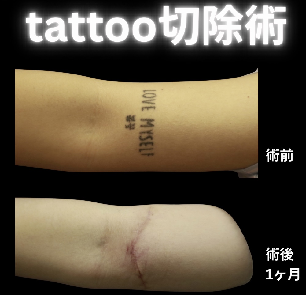 タトゥー切除術の症例写真