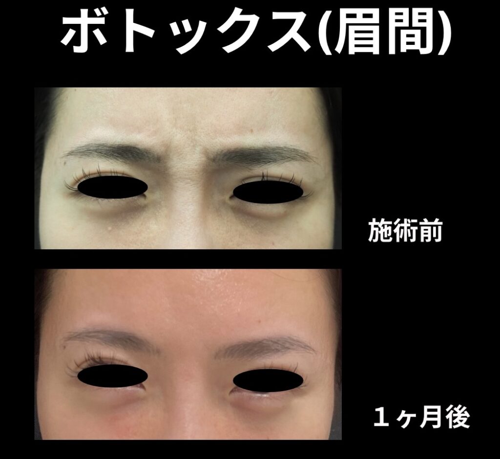 ボトックス注入(眉間)の症例写真