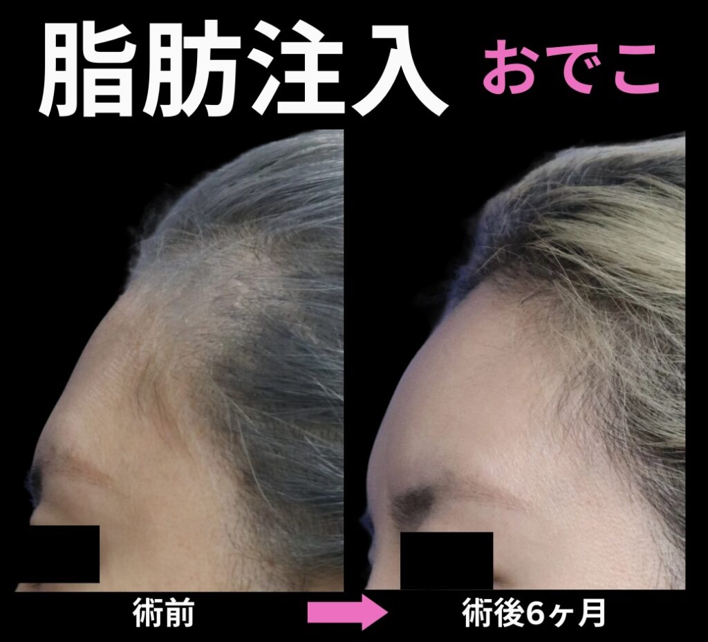 額への脂肪注入症例