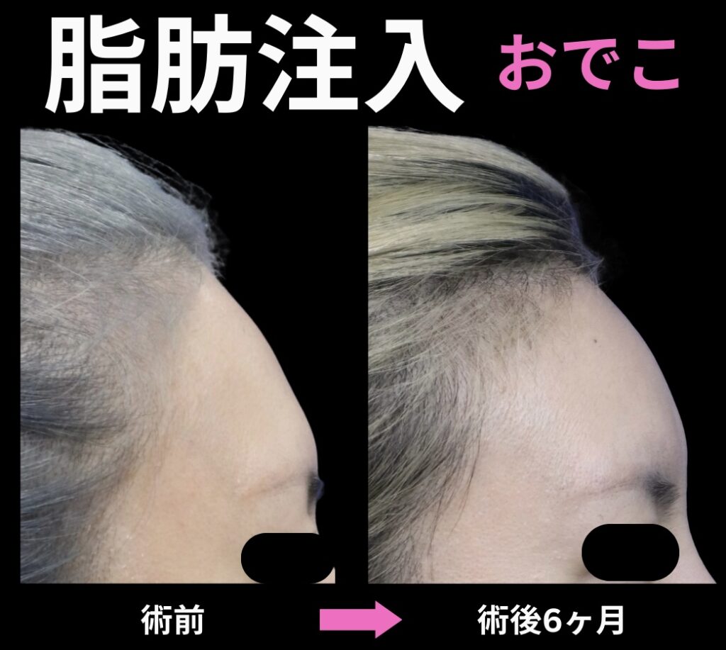 額への脂肪注入症例